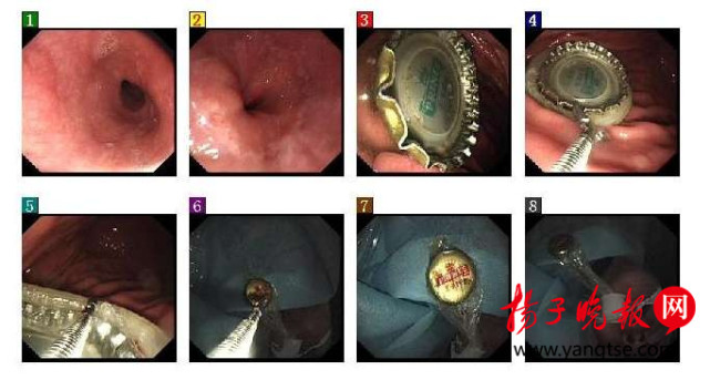 男子喝酒太猛吞下瓶盖 医生借避孕套将盖子取出